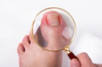 Symptoms and Causes of an Infected Ingrown Toenail