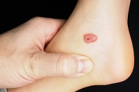 What Is a Blood Blister?