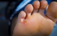 Definitions and Causes of Corns and Calluses