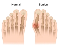 Cause and Care of Teen Bunions