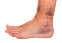 Causes and Symptoms of Acute Ankle Sprains